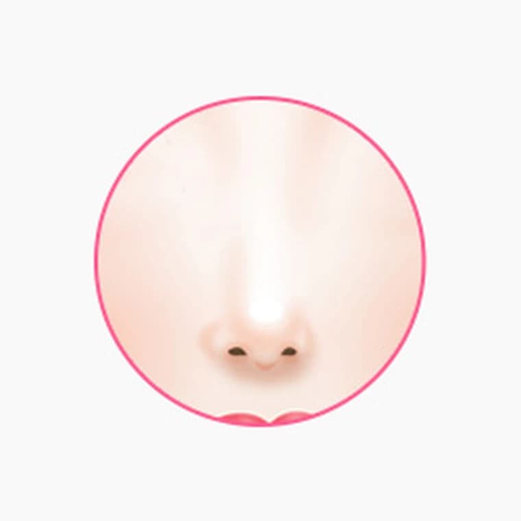 콧볼 교정