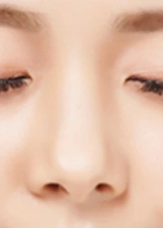 절개하지 않고 주사로 진행합니다 01 — 코 상태 확인