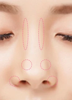 절개하지 않고 주사로 진행합니다 02 — 주입 자리 표시