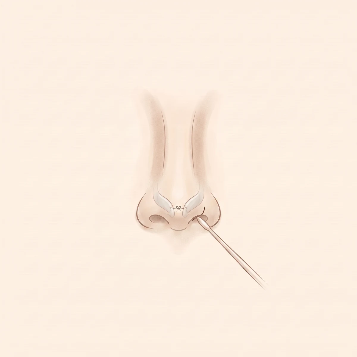 콧볼의 상태에 따라 달라지는 방법 03 — 복코 · 날개연골 정리