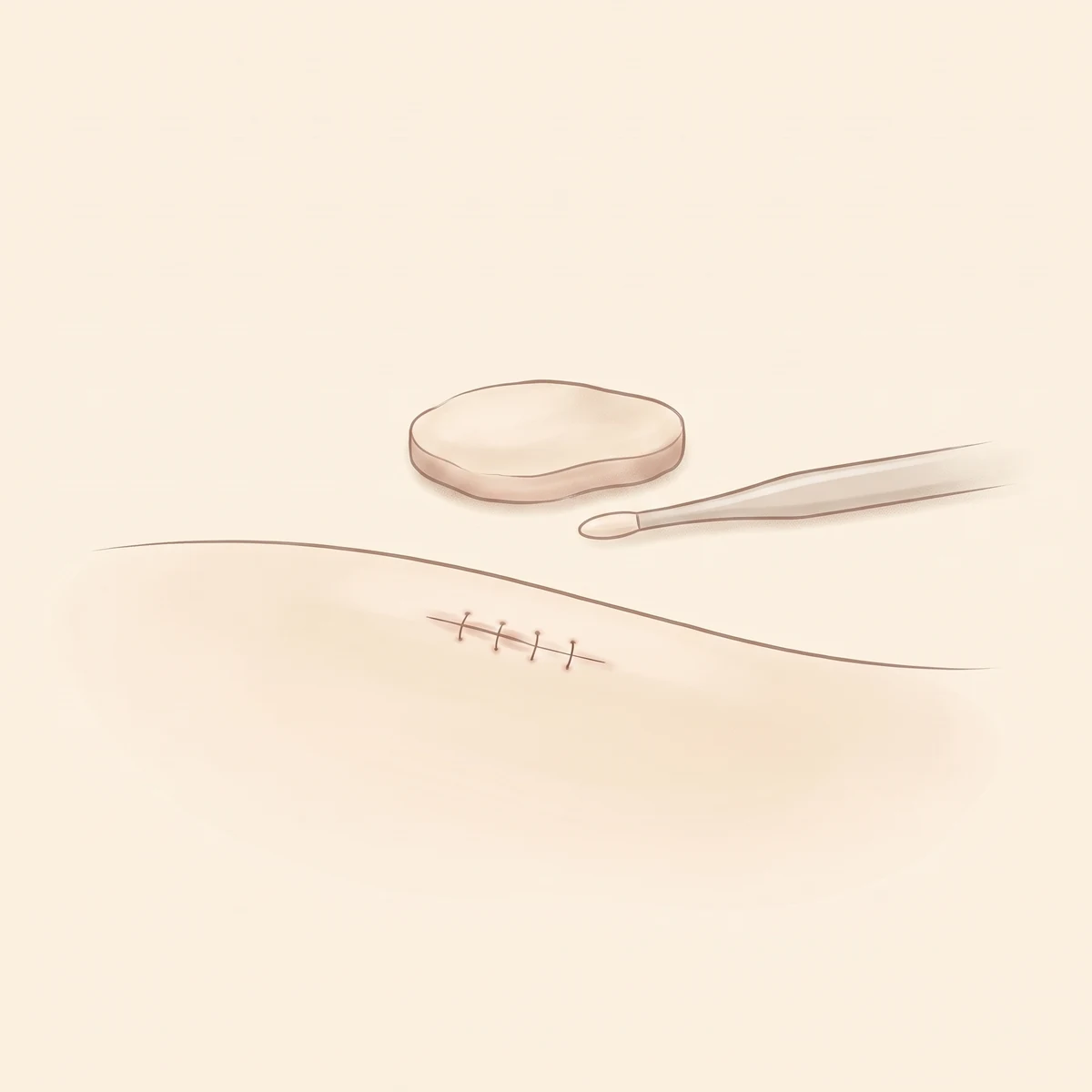 자가진피코성형 수술 과정 01 — 조직 선택 · 채취