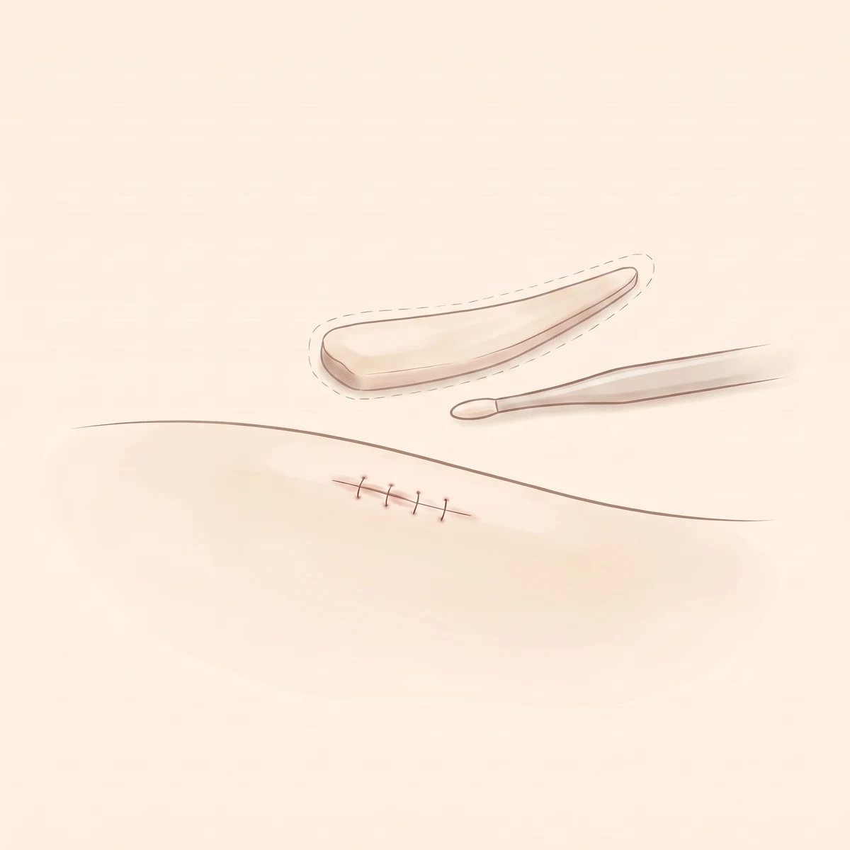 자가진피코성형 수술 과정 02 — 자가 보형물 디자인