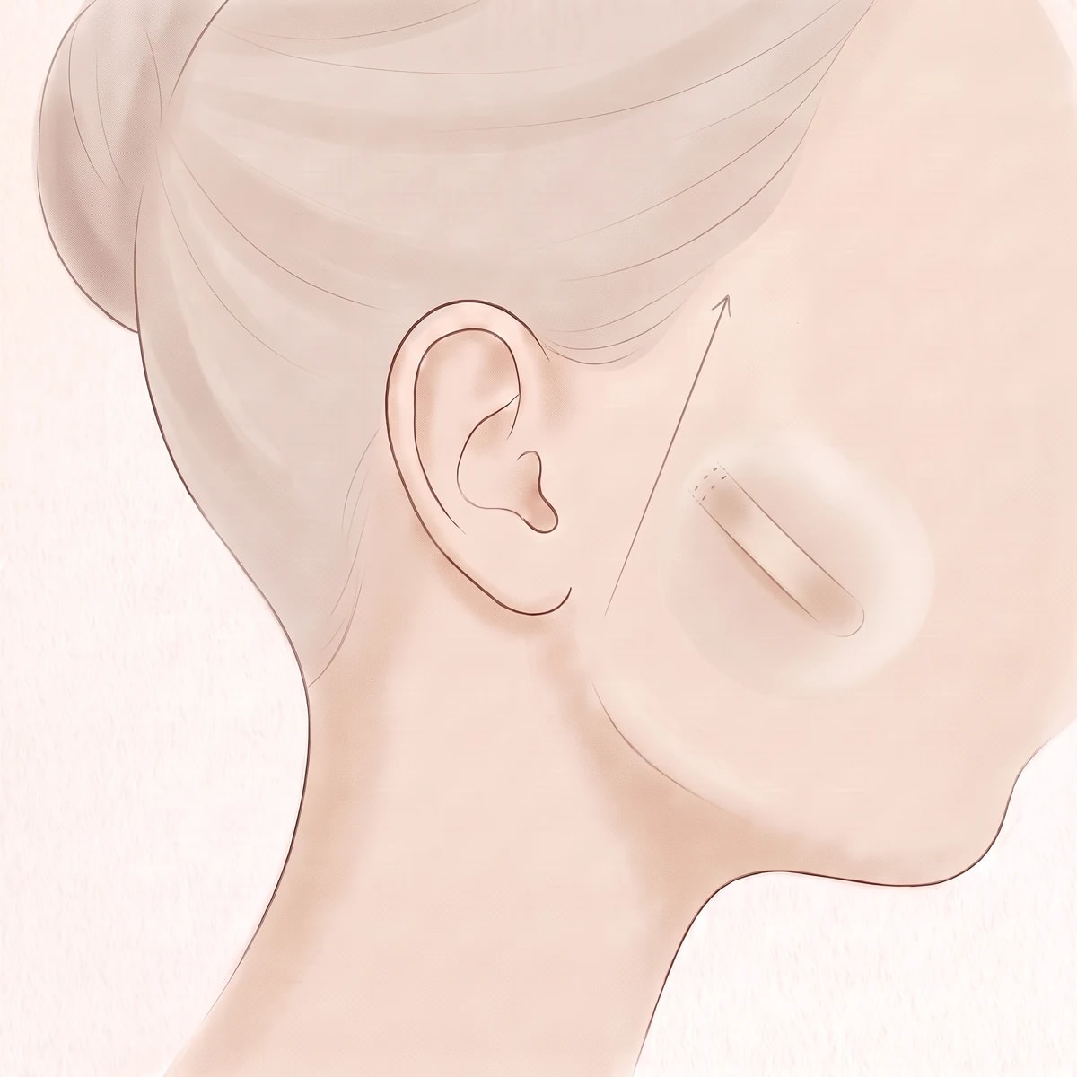 중안면거상 수술 과정 02 — 박리 · 거상