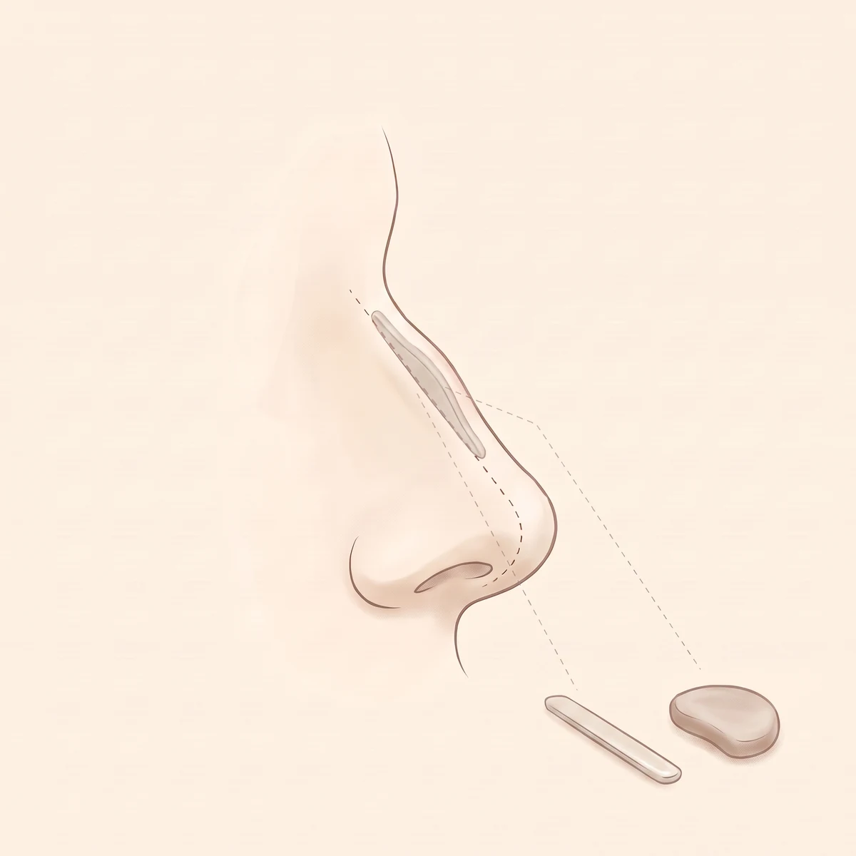 코재수술 진행 과정 02 — 재료 · 방법 결정