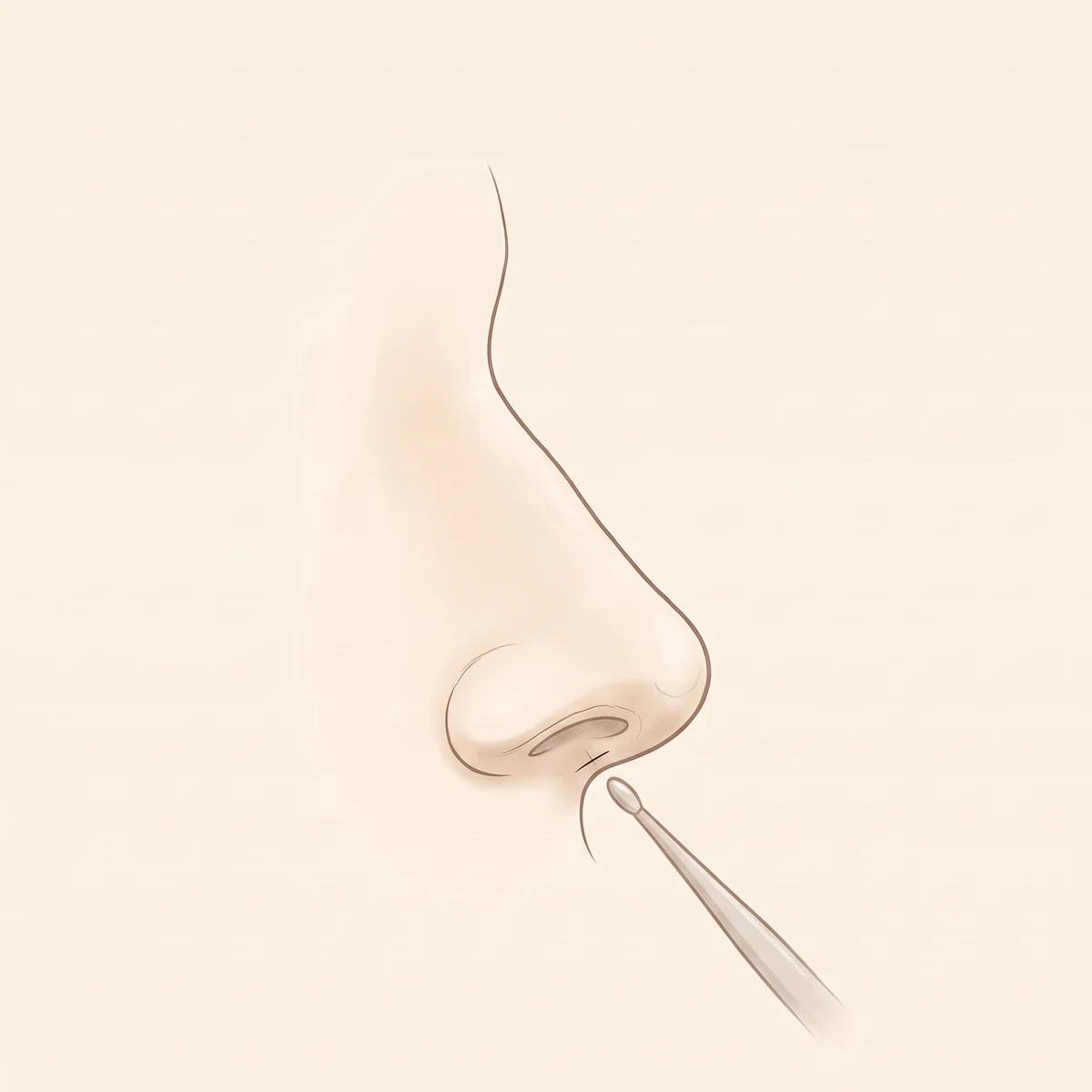 코성형 수술 과정 02 — 절개